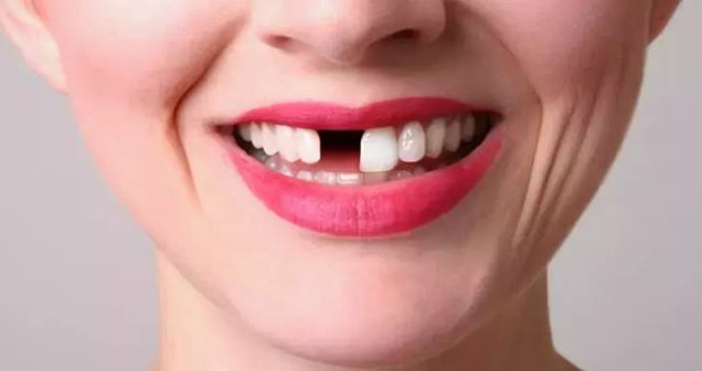 Rüyada Diş Dökülmesi Ne Anlama Gelir?